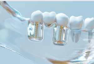 Best dental implants Adelaide