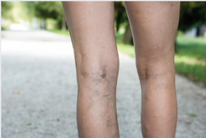 varicose vein treatment clinics Adelaide